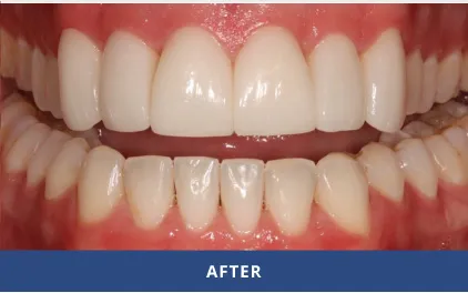 After Porcelain Veneers