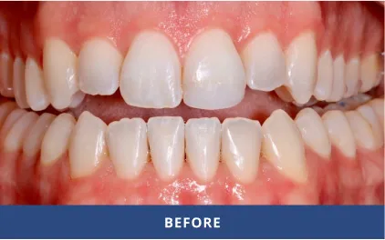 Before Porcelain Veneers