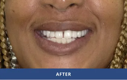 After Dental Implants