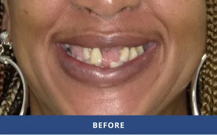 Before Dental Implants