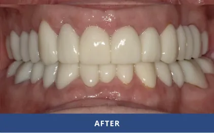 After Dental Veneers and Crowns