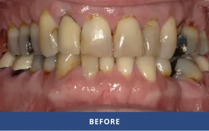 Before Dental Veneers and Crowns