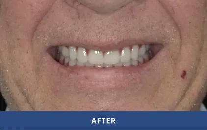 After Dental Implants