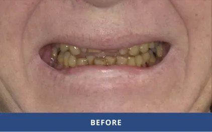 Before Dental Implants