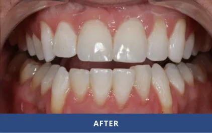 After Cosmetic Bonding