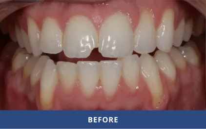 Before Cosmetic Bonding