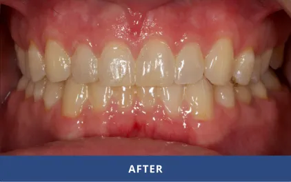 After Cosmetic Dentistry