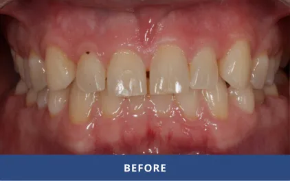 Before Cosmetic Dentistry